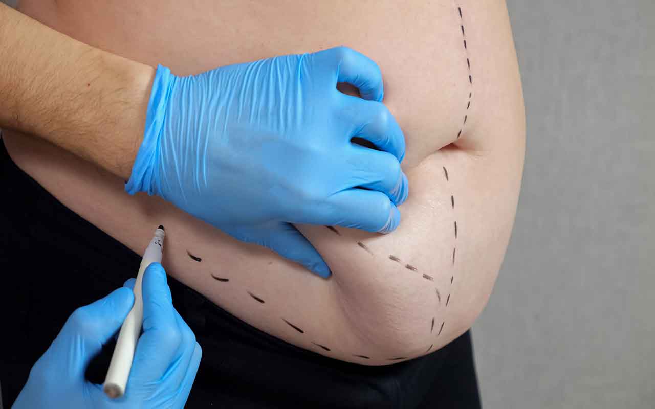 retendre une peau relâchée sans recourir à la chirurgie lourde